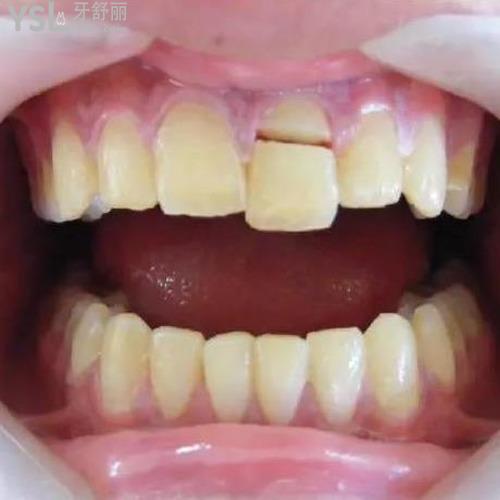 牙齒掉了一塊怎么處理？