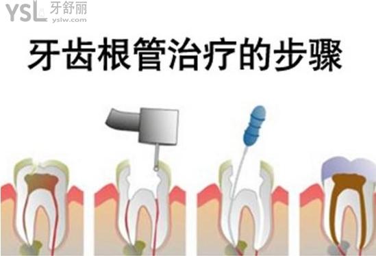 根管治療步驟