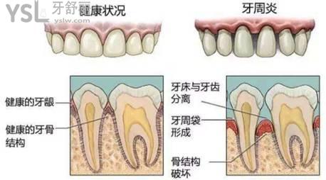 牙齒疾病造成牙縫變大