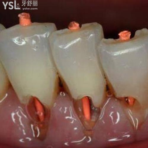牙漏神經(jīng)了怎么辦？