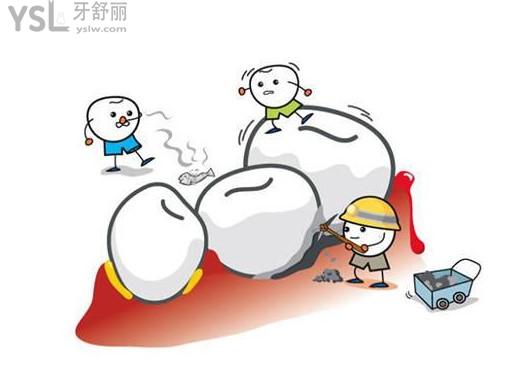 牙結(jié)石