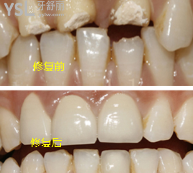 牙齒被打斷怎么修復(fù)