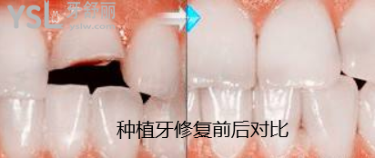 牙齒被打斷怎么修復(fù)