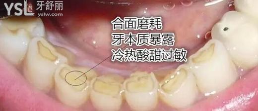成人磨牙齒怎么治療？