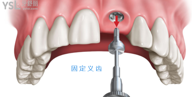 假牙怎么做上去的