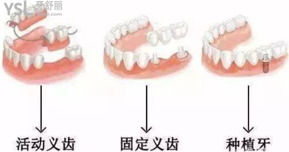假牙怎么做上去的
