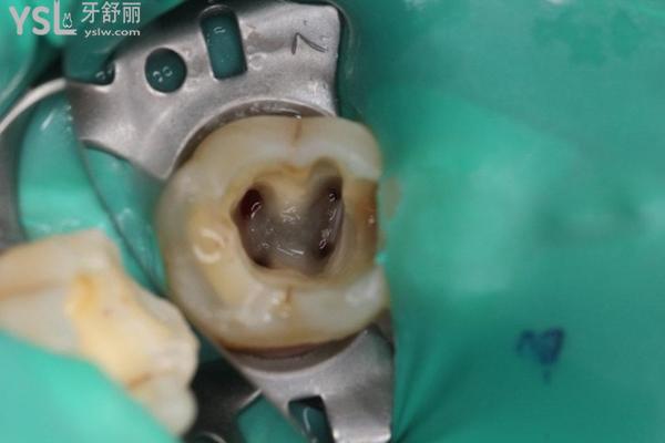 牙齒根管治療一直流血是什么原因？