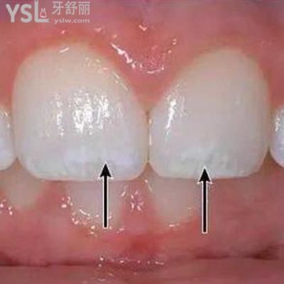 牙齒脫礦怎么治療？