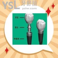 拔殘根多久種植牙比較好