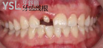 拔殘根多久種植牙比較好