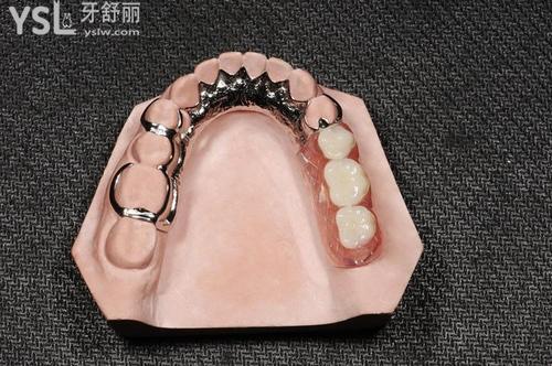 成人牙掉了可以做活動(dòng)義齒