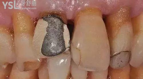 牙冠材料是烤瓷的好還是全瓷的好1