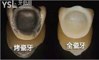 牙冠材料是烤瓷的好還是全瓷的好2