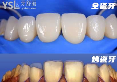 牙冠材料是烤瓷的好還是全瓷的好4