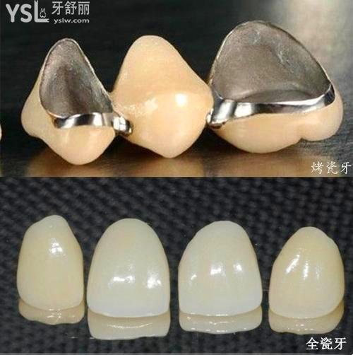 牙冠材料是烤瓷的好還是全瓷的好5