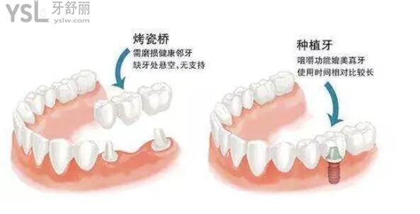 鑲牙和種植牙的對比