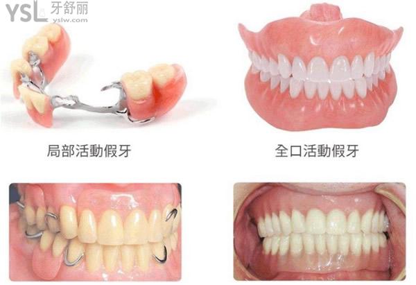 活動義齒圖片