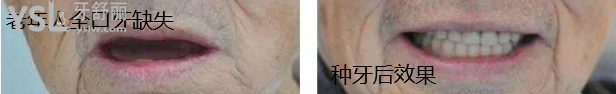 廣東免費(fèi)種牙推薦中家醫(yī)家庭口腔醫(yī)院