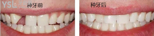 廣東免費(fèi)種牙推薦中家醫(yī)家庭口腔醫(yī)院
