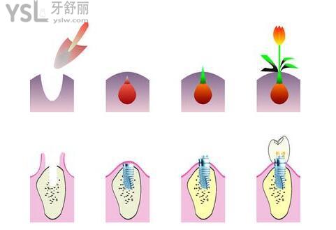 東莞哪里可以種牙 揭秘老年人種牙多少錢一顆.jpg