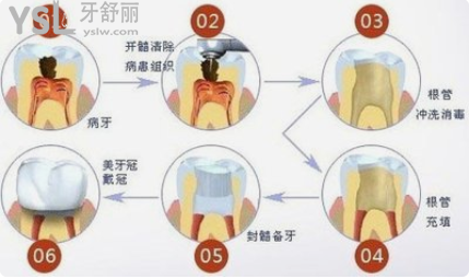 牙疼導(dǎo)致半邊臉疼怎么辦
