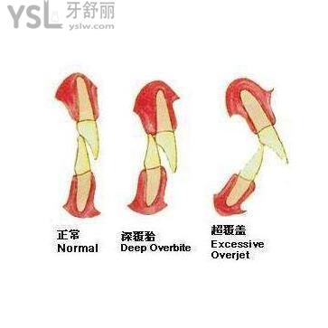 深覆合
