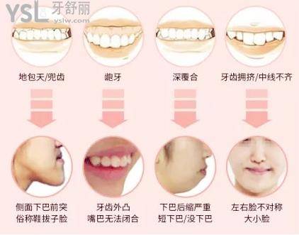 牙齒畸形幾種類型