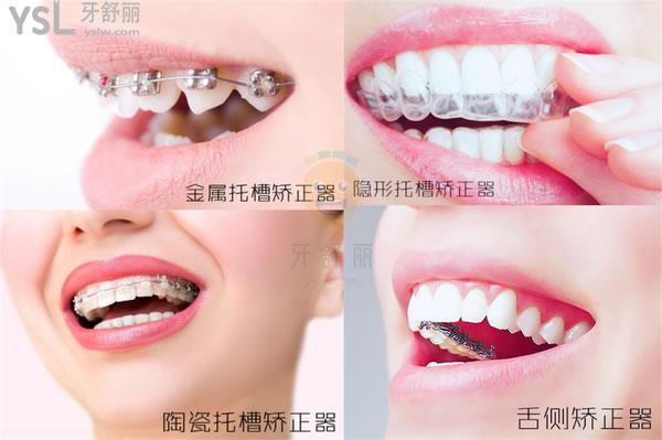 四種牙齒矯正方法及差別