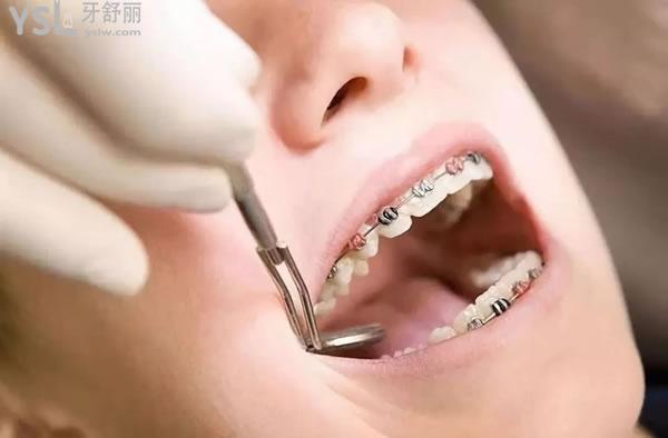 固定牙齒矯正器
