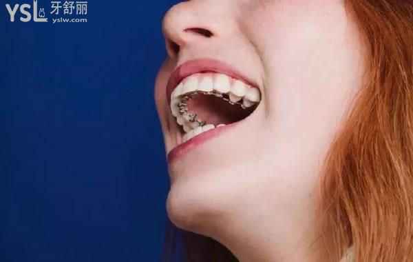 舌側(cè)牙齒矯正器