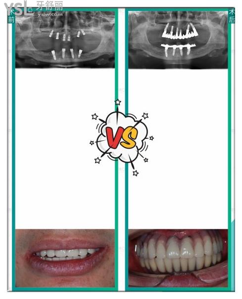 深圳登特口腔全口種植<span style=