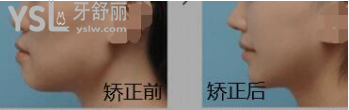 側(cè)臉不好看嘴突出怎么辦