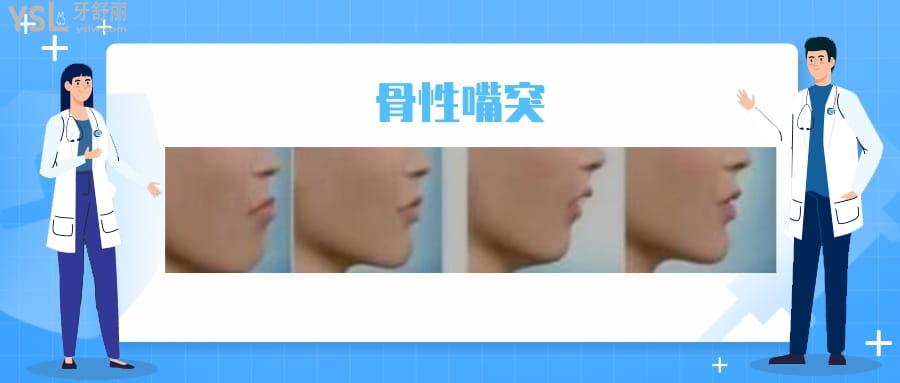 嘴突出側(cè)面很難看怎么矯正多少錢(qián)