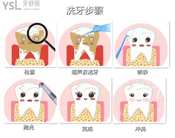 超聲波潔牙