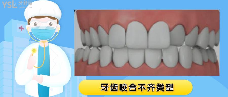 牙齒對(duì)不齊門牙跟下牙碰不到