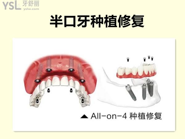 ALL-ON-4種植牙