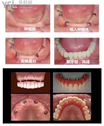 全口種植牙<span style=