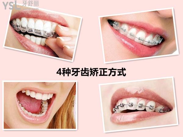 牙齒矯正的幾種方式