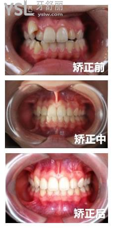 牙齒矯正成效圖