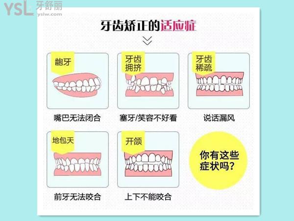 牙齒矯正的適應癥