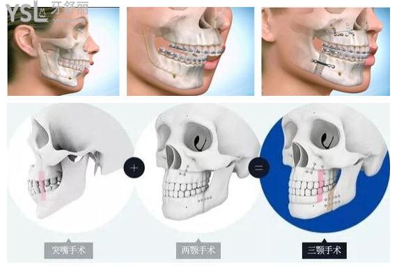 正頜手術
