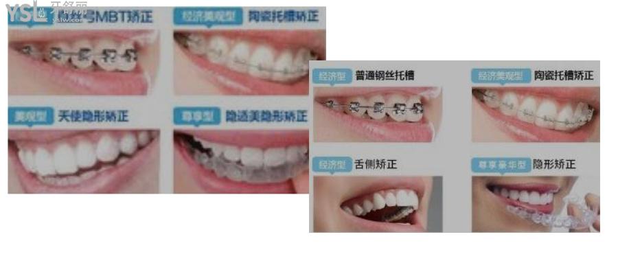 學(xué)生牙齒矯正大概要多少錢