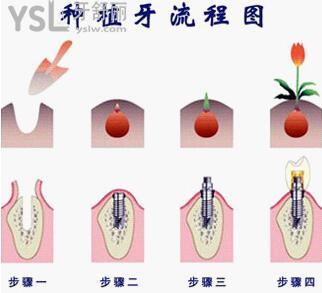 種植牙