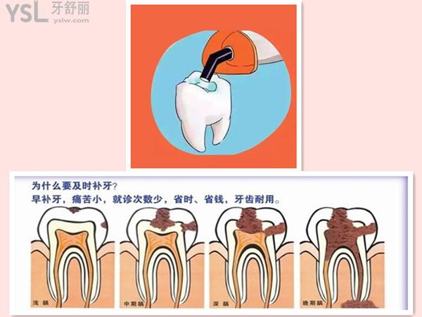 為什么要及時補(bǔ)牙