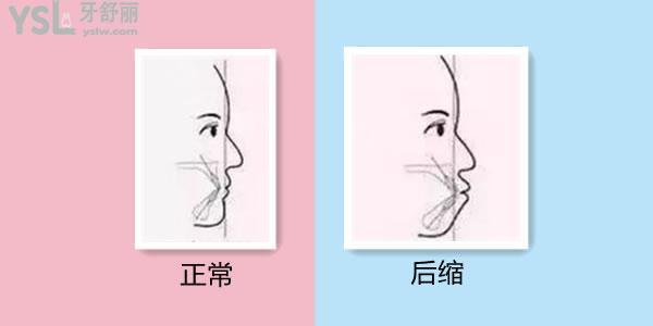  整牙對(duì)下巴后縮的治療有幫助嗎 幫助大嗎