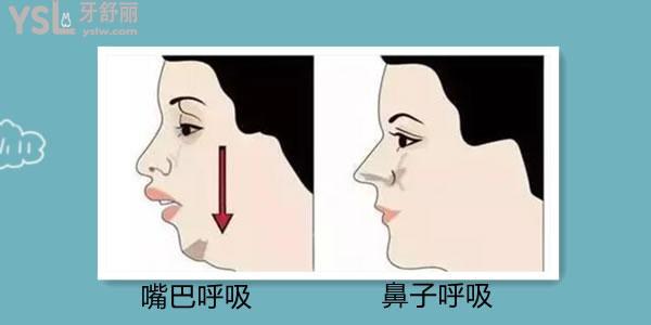  整牙對(duì)下巴后縮的治療有幫助嗎 幫助大嗎