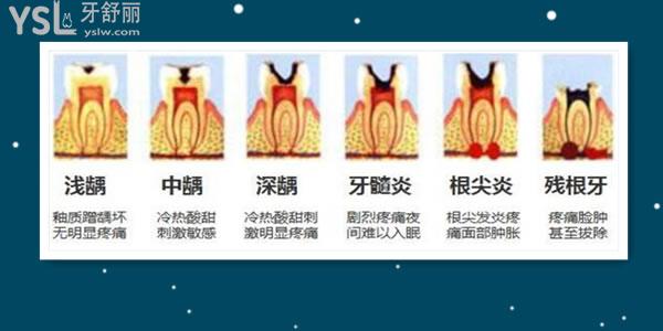 牙髓病是什么意思 牙髓炎該如何治療呢.jpg