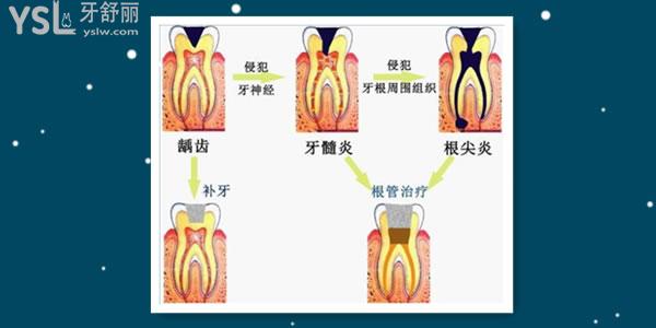 牙髓病是什么意思 牙髓炎該如何治療呢.jpg
