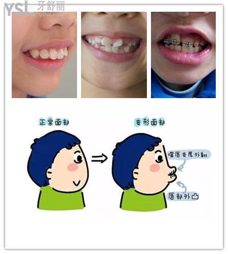 孩子比較好的矯正牙齒的年齡段是多少歲