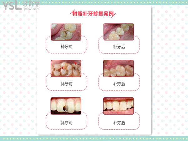 樹脂補(bǔ)牙對(duì)比圖